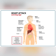 What Are the Symptoms of a Heart Attack: Early Warning Signs Reviews | RateItAll