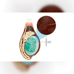 Surgical Sperm Retrieval in Hyderabad: Male Infertility Solution image